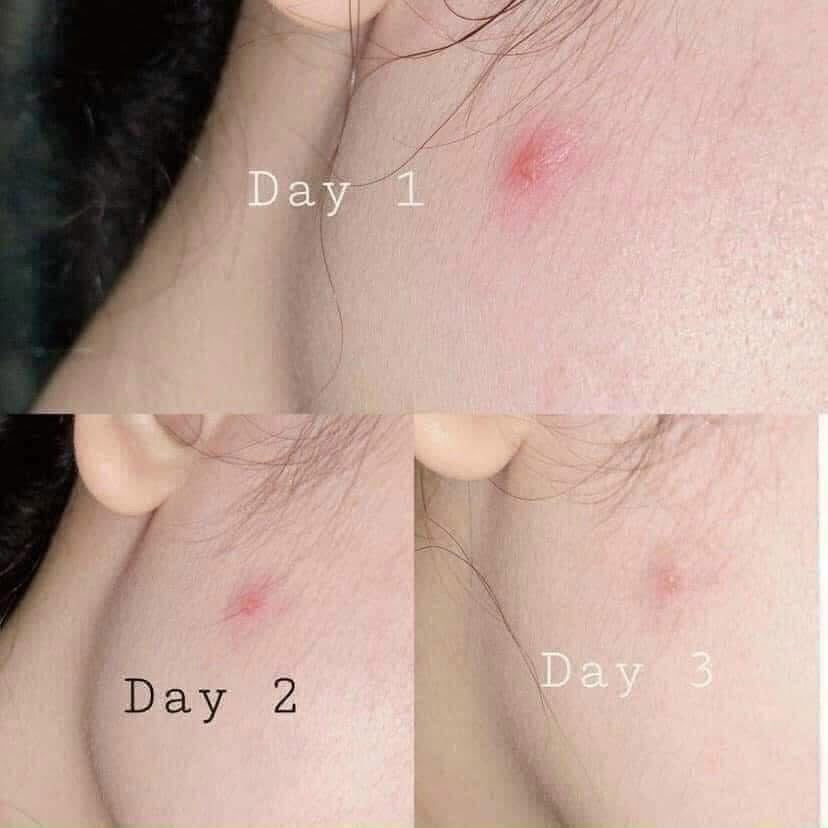 LUMOS - ACNE SERUM (5ml) image 7